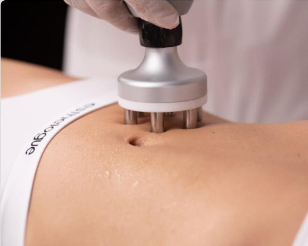 trattamenti corpo radiofrequenza